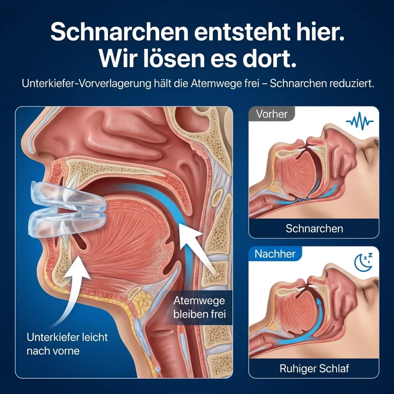 SilentNight – Anti-Schnarch Mundschutz anpassbar wiederverwendbar